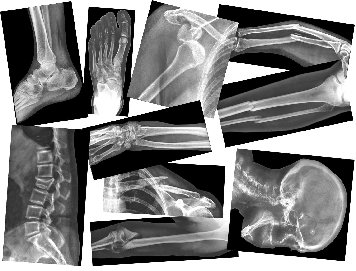 X-Rays of Broken Bones | Anderson Scientific
